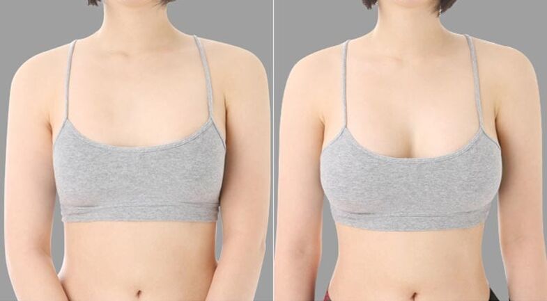 πριν και μετά την αυξητική στήθους