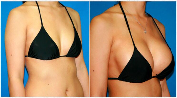 Πριν και μετά την αυξητική στήθους με πλαστική χειρουργική