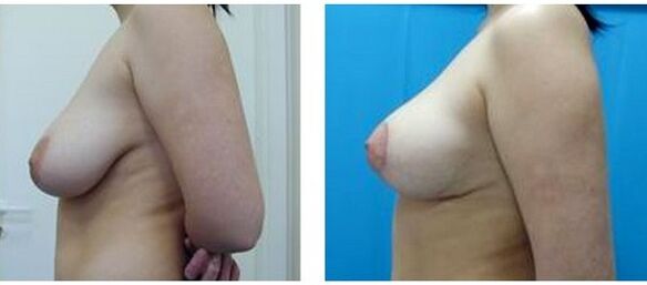 πριν και μετά την επέμβαση αύξησης του μαστού
