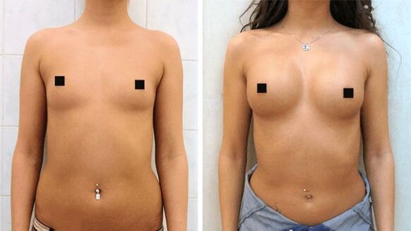 φωτογραφίες πριν και μετά τη χειρουργική αύξηση του μαστού