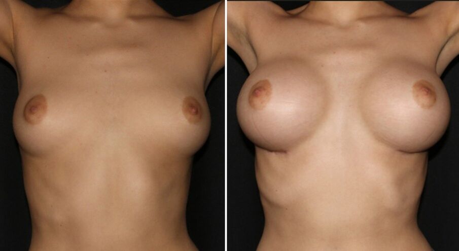 Πριν και μετά τη χειρουργική επέμβαση αύξησης του μαστού